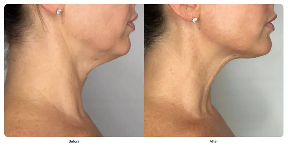 sofwave-double-chin-reduction-before-after-mexico