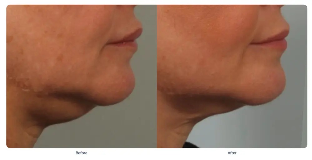 sofwave-double-chin-reduction-before-after-mexico