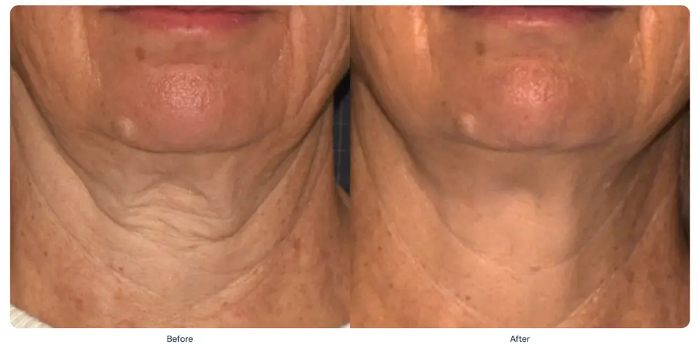 sofwave-neck-tightening-before-after-playa-del-carmen