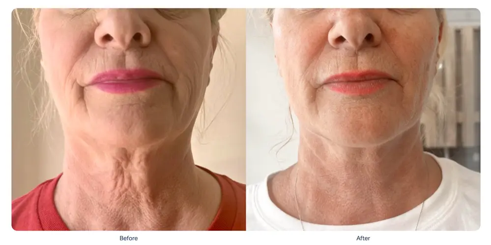 Submental tightening and double chin reduction before and after Sofwave session