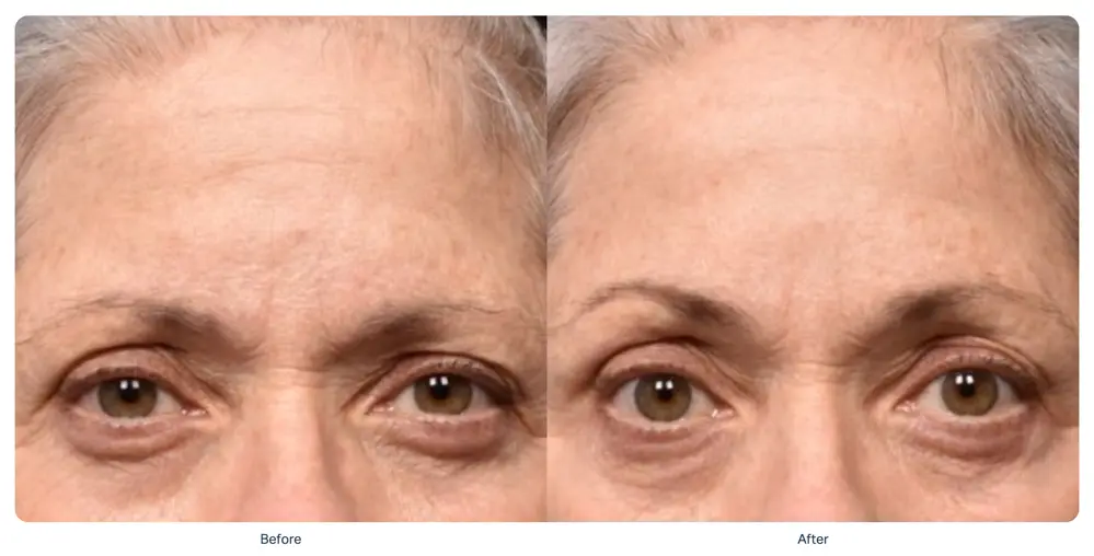 sofwave-eyebrow-lift-before-after-playa-del-carmen