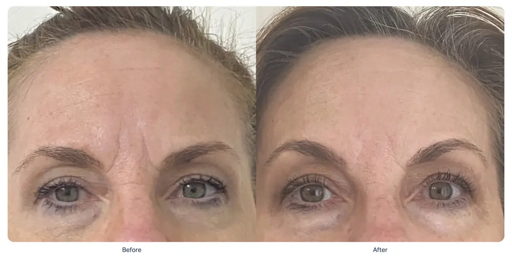 sofwave-forehead-wrinkle-reduction-before-after