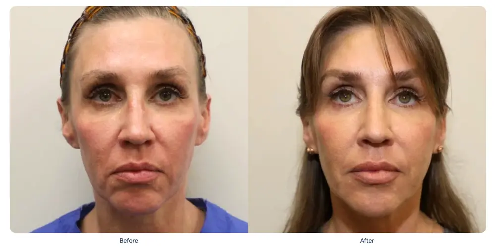 sofwave-full-face-lifting-before-after-playa-del-carmen