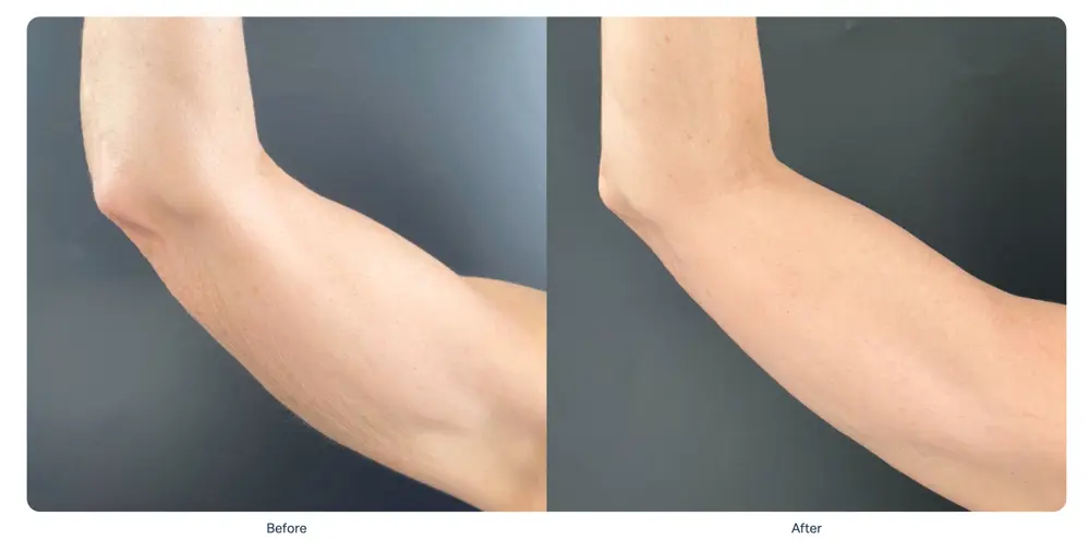 sofwave-arm-tightening-before-after-riviera-maya