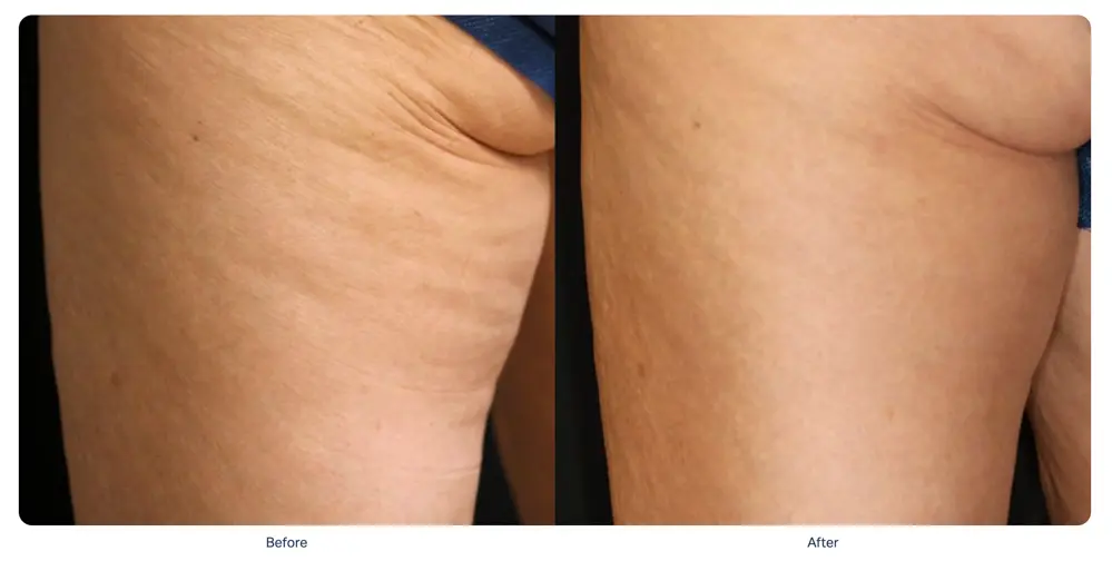 sofwave-arm-tightening-before-after-riviera-maya